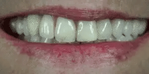 White snap-on dental veneers for upper and lower teeth with storage case